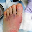 bunion-surgery-photo-by-knottyboy