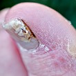 closeup-of-toenail-fungus