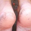 dry-cracked-heels