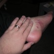 foot-sores