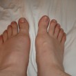 gout-swollen-foot