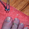ingrown-toenail-picture