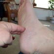 The heel pain I was experiencing was indeed Plantar Faciitis. photo by Curtis at TheFunTimesGuide.com