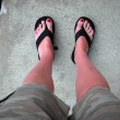 sunburned-feet-in-flip-flops