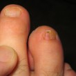 toenail-fungus