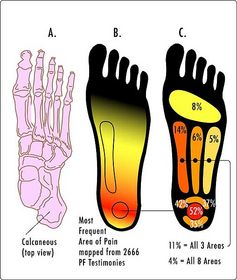 area-of-foot-pain-public-domain.jpg