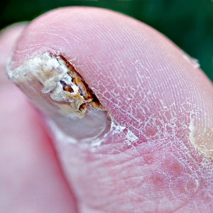 closeup-of-toenail-fungus-by-chefranden.jpg
