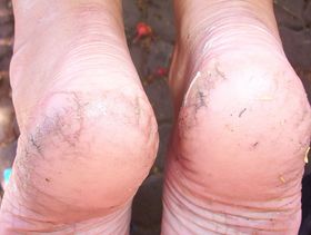 dry-cracked-heels-by-lanz.jpg
