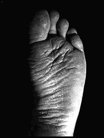 dry-foot-cracked-foot-by-Martin-Kingsley.jpg