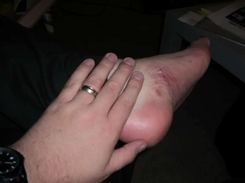 Diabetic Blisters Pictures