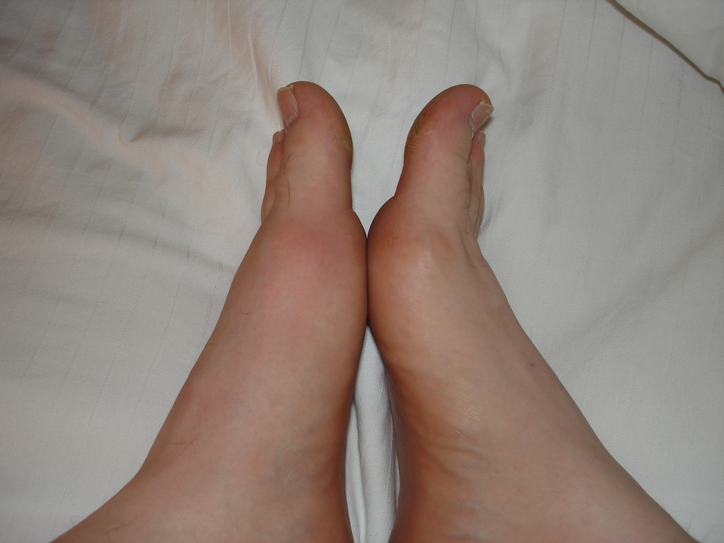 Gout Toe Pain