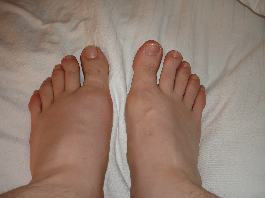 pictures of gout in feet