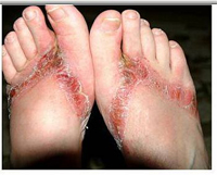 kerry-stiles-feet-burned-by-flip-flops.jpg