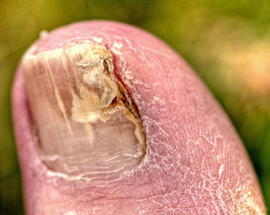 toenail-fungus-by-chefranden.jpg
