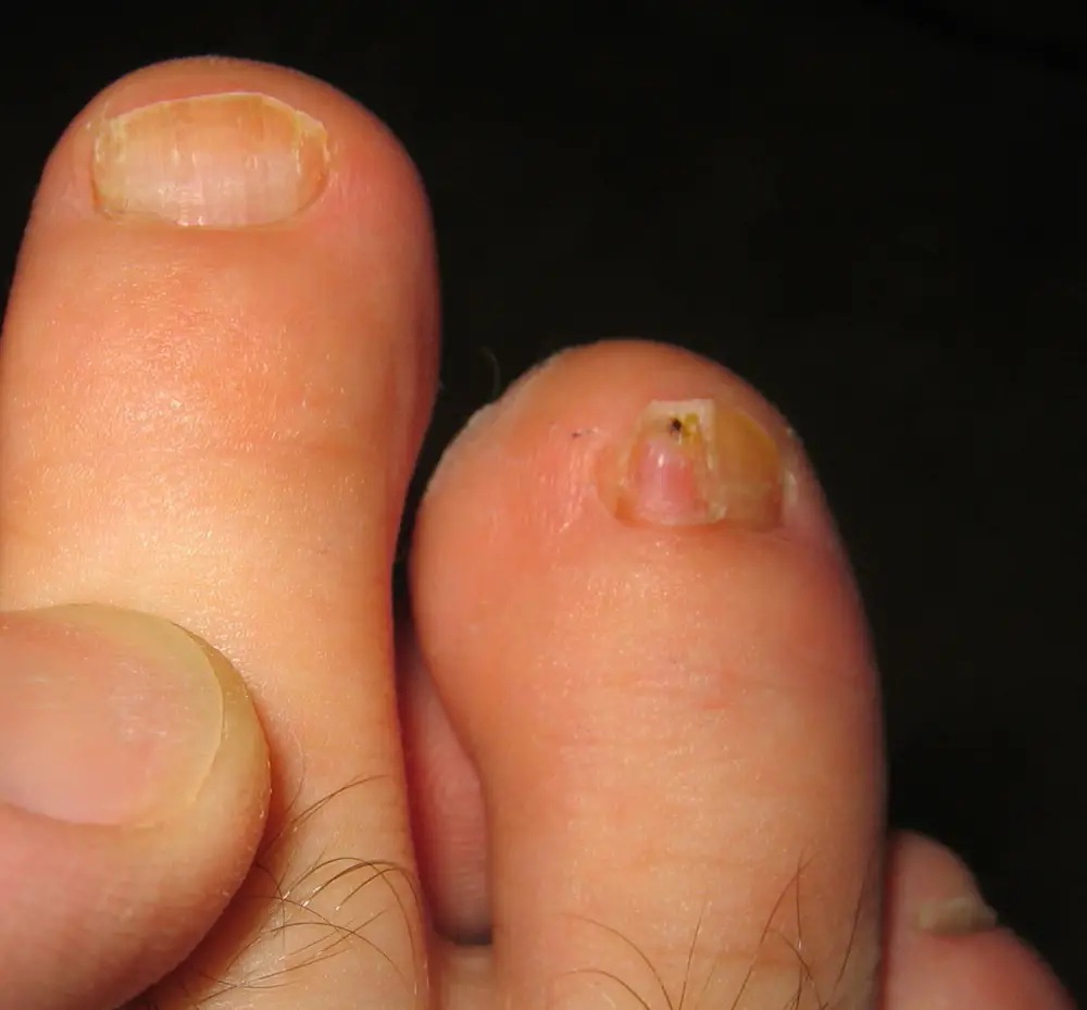 The most common type of toenail fungus in North America are dermatophytes