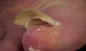 Toenail removal gone wrong.