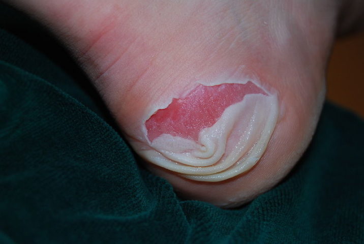 blisters on heels