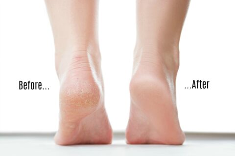 Before and after using a foot exfoliating scrub INSTEAD of a pumice stone or foot file.