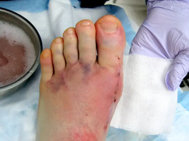 How long does it take you to heal after bunion surgery?