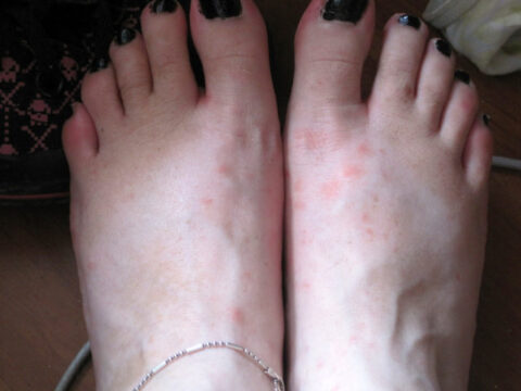 foot-allergies