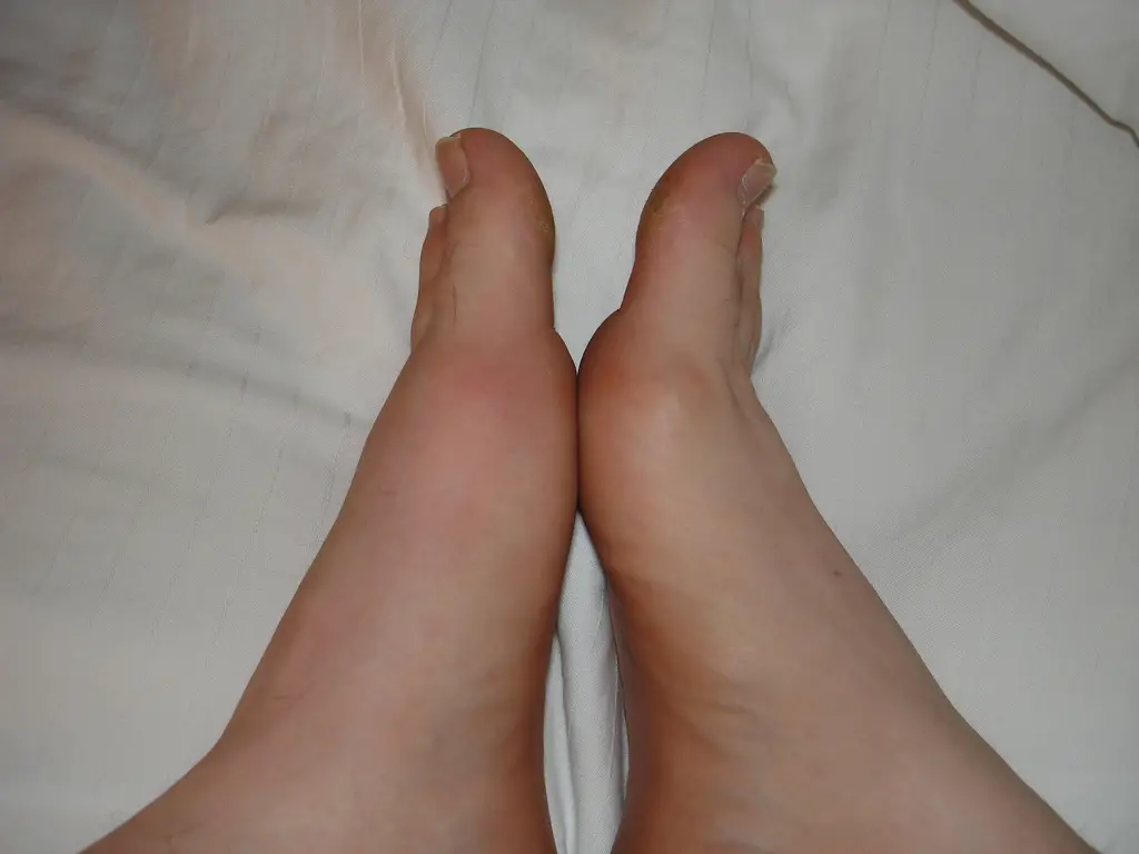 gout in toe